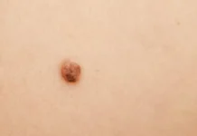 Campaña Nacional de Prevención de Cáncer de Piel: 18 y 20 de noviembre de 2025